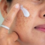 Os termômetros baixaram? Chegou a hora de tratar o Melasma